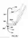 Fig. 14 - Anchoring System for Valve Replacement