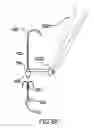 Fig. 17 - Anchoring System for Valve Replacement