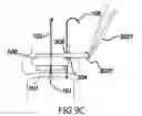 Fig. 20 - Anchoring System for Valve Replacement