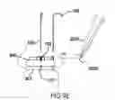 Fig. 22 - Anchoring System for Valve Replacement