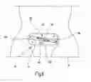 Fig. 07 - Device for fixing and tensioning at least one pulling thread for applying a neovagina