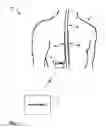 Fig. 02 - Shifting between electrode combinations in electrical stimulation device