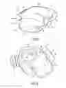 Fig. 03 - Gastric ring