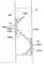 Fig. 01 - Ureteral stent
