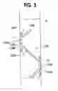 Fig. 05 - Ureteral stent