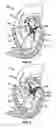 Fig. 04 - Methods, systems and devices for cardiac valve repair