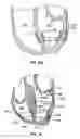Fig. 14 - Methods, systems and devices for cardiac valve repair