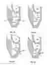 Fig. 15 - Methods, systems and devices for cardiac valve repair