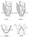 Fig. 16 - Methods, systems and devices for cardiac valve repair