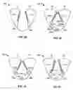Fig. 17 - Methods, systems and devices for cardiac valve repair