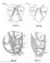 Fig. 20 - Methods, systems and devices for cardiac valve repair