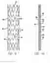 Fig. 07 - Covered stent with encapsulated ends