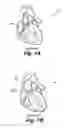 Fig. 02 - Replacement aortic valve leaflets and related technology