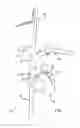 Fig. 02 - Method and apparatus for reducing mitral regurgitation