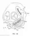 Fig. 28 - Method and apparatus for reducing mitral regurgitation