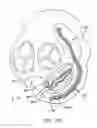 Fig. 30 - Method and apparatus for reducing mitral regurgitation