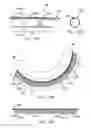 Fig. 41 - Method and apparatus for reducing mitral regurgitation