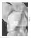 Fig. 06 - Articular surface implant
