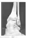 Fig. 08 - Articular surface implant