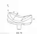 Fig. 11 - Articular surface implant