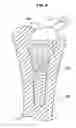 Fig. 05 - Artificial joint system