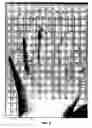 Fig. 09 - Method for creating covers for prosthetic devices and other dynamic supporting members