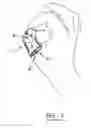 Fig. 04 - Finger protecting device and method for protecting at least one finger