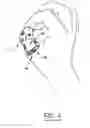 Fig. 05 - Finger protecting device and method for protecting at least one finger