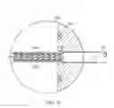 Fig. 07 - Loading stent with compressed air
