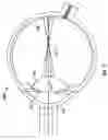 Fig. 08 - Method and apparatus for reducing or eliminating the progression of myopia