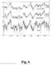 Fig. 05 - Hearing aid with adaptive compressor time constants