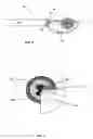 Fig. 03 - Methods and devices for the in situ dissolution of renal calculi