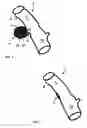 Fig. 03 - Diverticular remodling technique