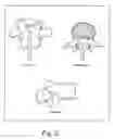 Fig. 03 - System and methods for improved access to vertebral bodies for kyphoplasty, vertebroplasty, vertebral body biopsy or screw placement