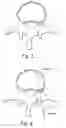 Fig. 04 - System and methods for improved access to vertebral bodies for kyphoplasty, vertebroplasty, vertebral body biopsy or screw placement