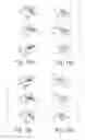 Fig. 16 - System and methods for improved access to vertebral bodies for kyphoplasty, vertebroplasty, vertebral body biopsy or screw placement