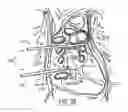 Fig. 05 - Facilitating tools for cardiac tissue ablation