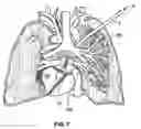 Fig. 09 - Vacuum coagulation probes