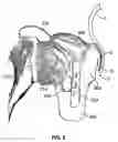 Fig. 11 - Vacuum coagulation probes