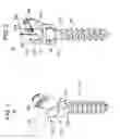 Fig. 02 - Spinal stabilization using bone anchor and anchor seat with tangential locking feature