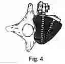 Fig. 07 - Method for the correction of spinal deformities using a rod-plate anterior system