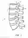 Fig. 02 - Flanged interbody fusion device