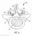 Fig. 05 - Flanged interbody fusion device