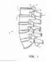 Fig. 02 - Orthopedic expansion fastener