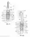 Fig. 07 - Expanding suture anchor having an actuator pin