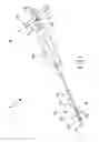 Fig. 02 - Devices, kit and method for kyphoplasty