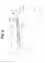 Fig. 07 - Extramedullary fluoroscopic alignment guide