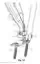 Fig. 08 - Multi-function orthopedic instrument