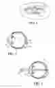 Fig. 02 - Ocular inlay with locator