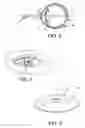 Fig. 03 - Ocular inlay with locator
